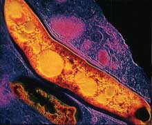 Tuberculosis